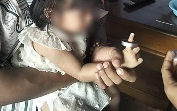 Bikin Panik! Seng Nyangkut di Telunjuk Bocil, BPBD Turun Tangan