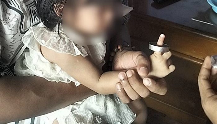 Bikin Panik! Seng Nyangkut di Telunjuk Bocil, BPBD Turun Tangan